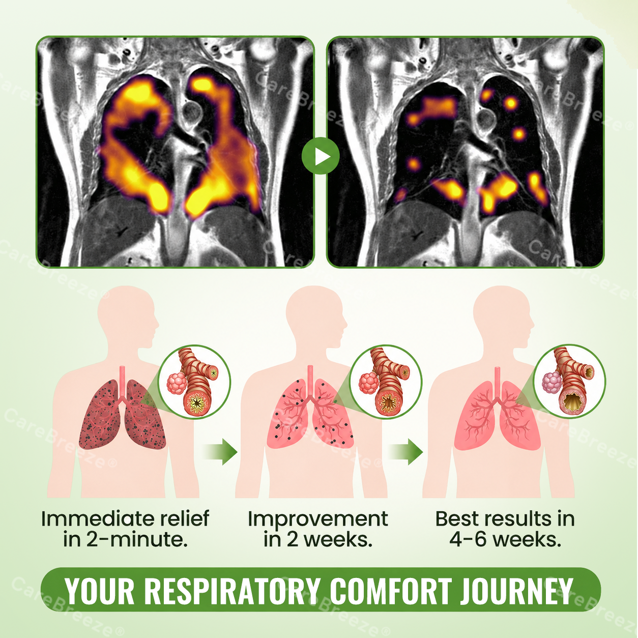 🇺🇸 ✅CareBreeze® Advanced Botanical Mullein Lung Cleanse Melt Strips（👨‍⚕️Directly acts on COPD, asthma, chronic bronchitis (CB), respiratory infections, lung cancer, sinusitis, and other conditions）