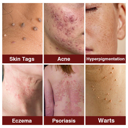 🐵✅US Owned and Operated：Pheromex®Dual-Action Plant Wart Removal Cream（👨‍⚕️Skin Tags,Acne,Hyperpigmentation,Eczema,Psoriasis,Rosacea,Warts)